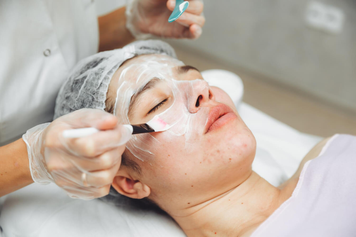 chemical-peels-improve-your-skin